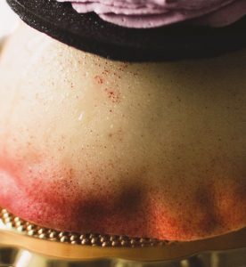 A woman with red and white spots on her body.
